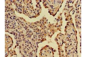 Immunohistochemistry of paraffin-embedded human lung cancer using ABIN7143798 at dilution of 1:100 (A2ML1 抗体  (AA 625-751))