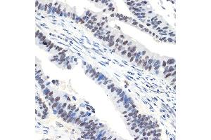 Immunohistochemistry of paraffin-embedded human colon carcinoma using N Rabbit mAb (ABIN7268774) at dilution of 1:100 (40x lens). (NAT10 抗体)