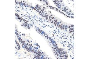 Immunohistochemistry of paraffin-embedded human colon carcinoma using N Rabbit mAb (ABIN7268774) at dilution of 1:100 (40x lens).