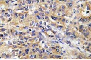 Immunohistochemistry (IHC) analyzes of COX17 antibody in paraffin-embedded human liver carcinoma tissue. (COX17 抗体)