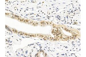 ABIN7094862 and ABIN7098913 at 1/100 staining Human kidney cancer by IHC-P. (HAS2 抗体  (C-Term))
