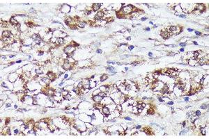 Immunohistochemistry of paraffin-embedded Human liver cancer using MTHFD2 Polyclonal Antibody at dilution of 1:100 (40x lens). (MTHFD2 抗体)