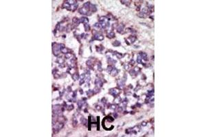 Immunohistochemistry (Paraffin-embedded Sections) (IHC (p)) image for anti-LATS, Large Tumor Suppressor, Homolog 1 (Drosophila) (LATS1) (AA 1-30), (N-Term) antibody (ABIN391033)