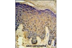 HAUS4 Antibody (C-term) (ABIN651422 and ABIN2840229) IHC analysis in formalin fixed and paraffin embedded skin carcinoma followed by peroxidase conjugation of the secondary antibody and DAB staining. (C14orf94 抗体  (C-Term))