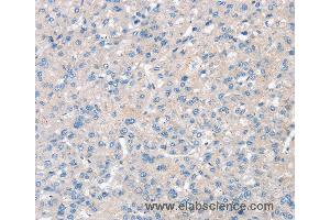 Immunohistochemistry of Human liver cancer using SNX3 Polyclonal Antibody at dilution of 1:30 (Sorting Nexin 3 抗体)