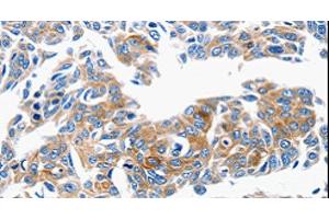 Immunohistochemistry of paraffin-embedded Human lung cancer tissue using CCL6 Polyclonal Antibody at dilution 1:50 (CCL6 抗体)