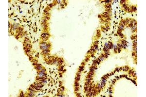IHC image of ABIN7127297 diluted at 1:100 and staining in paraffin-embedded human colon cancer performed on a Leica BondTM system. (Recombinant HIST1H4A 抗体)