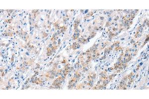 Immunohistochemistry of paraffin-embedded Human gastric cancer tissue using PAPSS1 Polyclonal Antibody at dilution 1:40 (PAPSS1 抗体)
