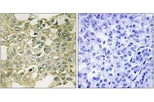Immunohistochemistry analysis of paraffin-embedded human breast carcinoma, using MYT1 (Phospho-Ser83) Antibody. (MYT1 抗体  (pSer83))