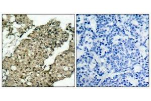 Immunohistochemical analysis of paraffin-embedded human breast carcinoma tissue using G3BP-1(Phospho-Ser232) Antibody(left) or the same antibody preincubated with blocking peptide(right). (G3BP1 抗体  (pSer232))