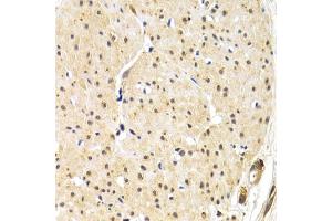 Immunohistochemistry of paraffin-embedded human gastric cancer using TERF1 antibody (ABIN1683138, ABIN3015078, ABIN3015079 and ABIN6213631) at dilution of 1:200 (40x lens). (TRF1 抗体  (AA 240-419))