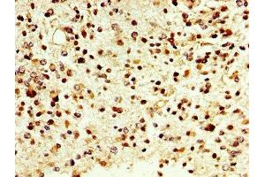 IHC image of ABIN7149450 diluted at 1:500 and staining in paraffin-embedded human glioma cancer performed on a Leica BondTM system. (D Amino Acid Oxidase 抗体  (AA 1-347))