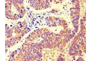Immunohistochemistry of paraffin-embedded human ovarian cancer using ABIN7169495 at dilution of 1:100 (SH3BP5 抗体  (AA 49-455))