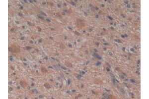 Detection of GSTm4 in Human Glioma Tissue using Polyclonal Antibody to Glutathione S Transferase Mu 4 (GSTm4) (GSTM4 抗体  (AA 18-215))
