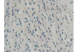 Detection of ABI1 in Human Prostate cancer Tissue using Polyclonal Antibody to Abl Interactor 1 (ABI1) (ABI1 抗体  (AA 1-182))