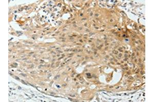 The image on the left is immunohistochemistry of paraffin-embedded Human cervical cancer tissue using ABIN7193012(VEGFA Antibody) at dilution 1/25, on the right is treated with synthetic peptide.
