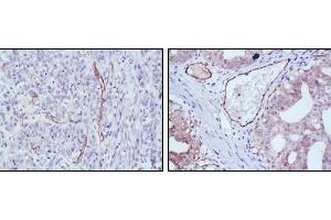 Immunohistochemical analysis of paraffin-embedded human stomach cancer (left) and ovary cancer (right) tissues using eNOS mouse mAb with DAB staining. (ENOS 抗体)