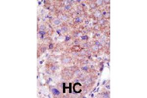 Formalin-fixed and paraffin-embedded human hepatocellular carcinoma tissue reacted with SMURF2 polyclonal antibody  , which was peroxidase-conjugated to the secondary antibody, followed by DAB staining. (SMURF2 抗体  (AA 702-731))