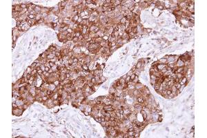 IHC-P Image Immunohistochemical analysis of paraffin-embedded human breast cancer, using FIG4, antibody at 1:500 dilution. (FIG4 抗体  (Center))