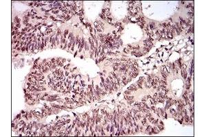 Immunohistochemical analysis of paraffin-embedded human rectum cancer tissues using TBLR1 mouse mAb with DAB staining.