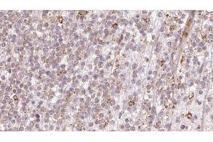 ABIN6273204 at 1/100 staining Human lymph cancer tissue by IHC-P. (CALCOCO2 抗体  (Internal Region))