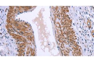Immunohistochemistry of paraffin-embedded Human cervical cancer tissue using GNPAT Polyclonal Antibody at dilution 1:40 (GNPAT 抗体)