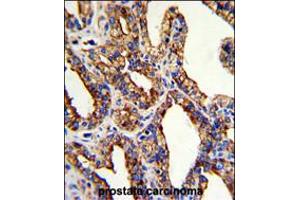 Formalin-fixed and paraffin-embedded human prostate carcinoma with TROP2 Antibody , which was peroxidase-conjugated to the secondary antibody, followed by DAB staining.