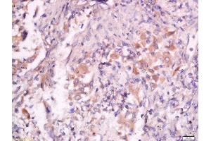 Formalin-fixed and paraffin embedded human lung carcinoma labeled with Anti- Pan FOXD Polyclonal Antibody, Unconjugated  at 1:200 followed by conjugation to the secondary antibody and DAB staining. (FOXD (AA 131-230) 抗体)