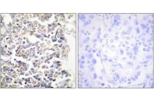Immunohistochemistry analysis of paraffin-embedded human lung carcinoma tissue, using MARK3 Antibody. (MARK3 抗体  (AA 1-50))