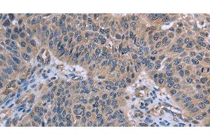 Immunohistochemistry of paraffin-embedded Human lung cancer using p53RFP Polyclonal Antibody at dilution of 1:50 (RNF144B 抗体)