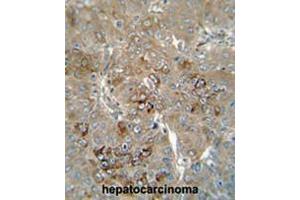 CES4 antibody (N-term) immunohistochemistry analysis in formalin fixed and paraffin embedded human hepatocarcinoma followed by peroxidase conjugation of the secondary antibody and DAB staining. (CES1P1 抗体  (N-Term))