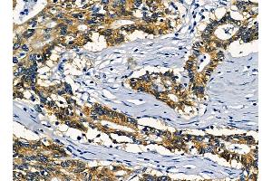KIAA1522 Antibody at 1/100 staining human prostate cancer by IHC-P. (KIAA1522 抗体)