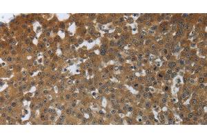 Immunohistochemistry of paraffin-embedded Human breast cancer tissue using PTPRM Polyclonal Antibody at dilution 1:40 (PTPRM 抗体)