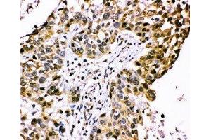 Anti-CISH antibody, IHC(P) IHC(P): Human Lung Cancer Tissue (CISH 抗体  (C-Term))