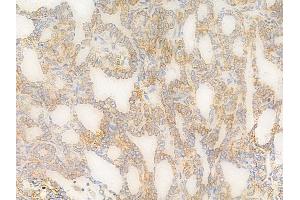 ABIN6258669 and ABIN6275117 at 1/100 staining human thyroid carcinoma by IHC-P.