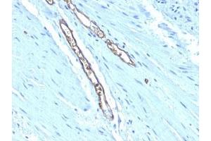 Formalin-fixed, paraffin-embedded human colon carcinoma stained with Blood Group Antigen A antibody (HE-193) (ABO, Blood Group A Antigen 抗体)