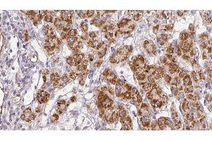 ABIN6278853 at 1/100 staining Human liver cancer tissue by IHC-P. (CALY 抗体  (Internal Region))