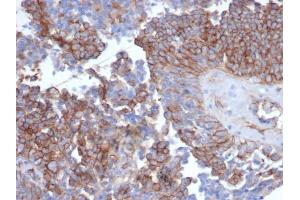Formalin-fixed, paraffin-embedded human ovarian carcinoma stained with N-Cadherin Recombinant Rabbit Monoclonal Antibody (CDH2/6857R). (Recombinant N-Cadherin 抗体)