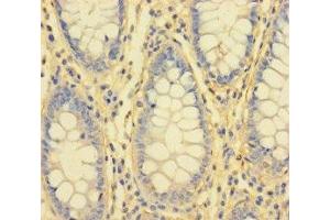 Immunohistochemistry of paraffin-embedded human colon cancer using ABIN7156759 at dilution of 1:100 (IL1RL2 抗体  (AA 20-218))