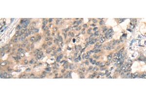 Immunohistochemistry of paraffin-embedded Human liver cancer tissue using BBOX1 Polyclonal Antibody at dilution of 1:45(x200) (BBOX1 抗体)
