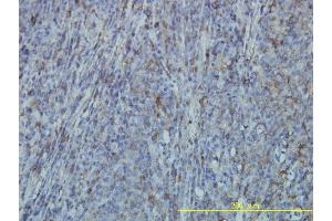 Immunoperoxidase of monoclonal antibody to FLNA on formalin-fixed paraffin-embedded human lymphoma tissue. (Filamin A 抗体  (AA 1-838))