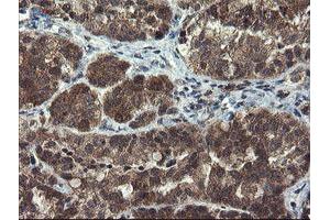 Immunohistochemical staining of paraffin-embedded Adenocarcinoma of Human ovary tissue using anti-MLF1 mouse monoclonal antibody. (MLF1 抗体)