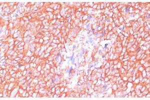 Immunohistochemistry of paraffin-embedded Human oophoroma using MOB4 Polyclonal Antibody at dilution of 1:100 (40x lens). (MOBKL3 抗体)