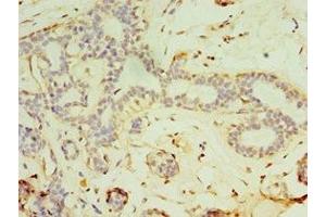 Immunohistochemistry of paraffin-embedded human breast cancer using ABIN7152819 at dilution of 1:100 (FGF6 抗体  (AA 38-208))