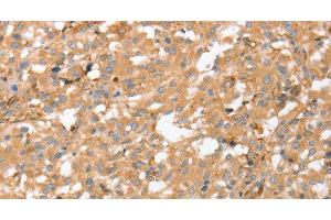 Immunohistochemistry of paraffin-embedded Human thyroid cancer using AHSG Polyclonal Antibody at dilution of 1:60 (Fetuin A 抗体)