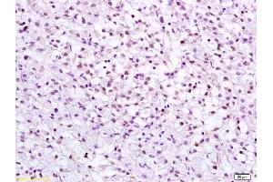 Formalin-fixed and paraffin embedded human gastric carcinoma labeled with Anti CHK2 Polyclonal Antibody, Unconjugated (ABIN685867) at 1:200 followed by conjugation to the secondary antibody and DAB staining (CHEK2 抗体  (AA 101-250))