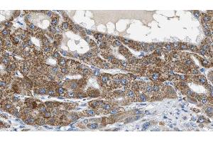 ABIN6269254 at 1/100 staining Human liver cancer tissue by IHC-P. (ZAP70 抗体  (Internal Region))