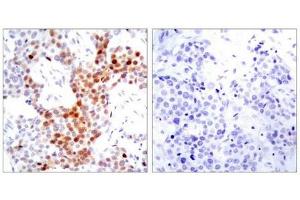 Immunohistochemical analysis of paraffin-embedded human breast carcinoma tissue using ATF2(Phospho-Thr69 or 51) Antibody(left) or the same antibody preincubated with blocking peptide(right).