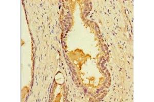 Immunohistochemistry of paraffin-embedded human prostate cancer using ABIN7158346 at dilution of 1:100 (LIMS3 抗体  (AA 1-117))