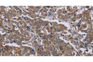 Immunohistochemistry of paraffin-embedded Human liver cancer using GGCX Polyclonal Antibody at dilution of 1:50 (GGCX 抗体)